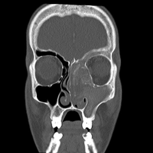 Allergic Fungal Sinusitis Image