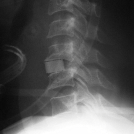 Cervical Interbody Strut Graft - Cloward Procedure 