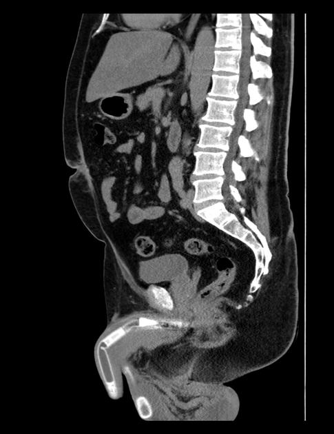 Penile implant Radiology Reference Article Radiopaedia