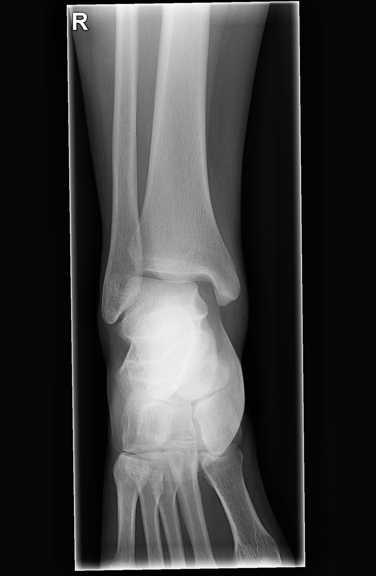 Maisonneuve fracture Image