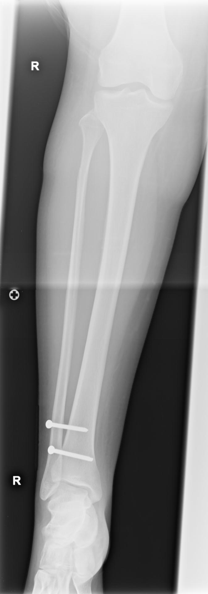 Maisonneuve fracture Image