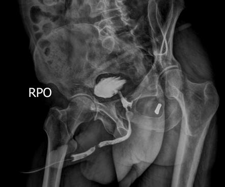 Urethral stricture | Radiology Case | Radiopaedia.org