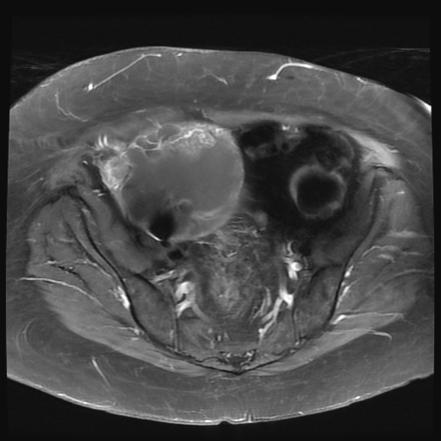 Metastatic endometrioid adenocarcinoma of the ovary | Image ...