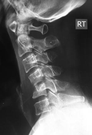 Spondylodiscitis | Radiology Reference Article | Radiopaedia.org