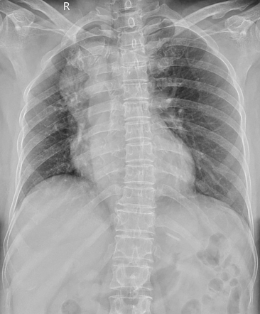 Right Sided Aortic Arch With Kommerell Diverticulum Radiology Case Radiopaedia Org