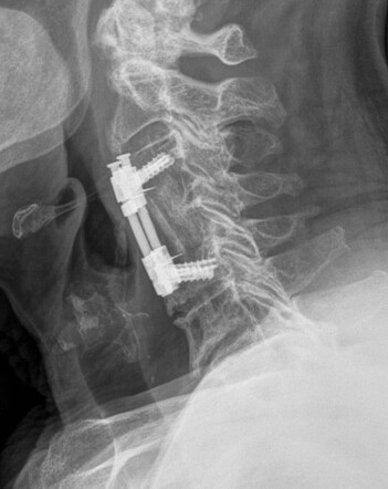 ACDF with translational device (DOC) | Radiology Case | Radiopaedia.org