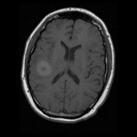 Metastatic melanoma | Image | Radiopaedia.org