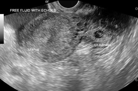 Live ectopic pregnancy | Radiology Case | Radiopaedia.org