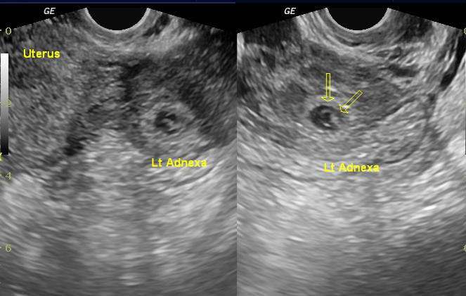 Live ectopic pregnancy | Image | Radiopaedia.org