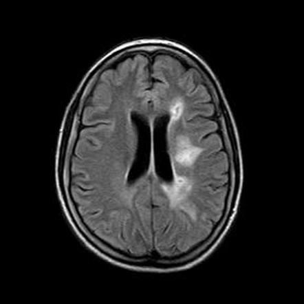 Watershed cerebral infarction | Radiology Reference Article ...