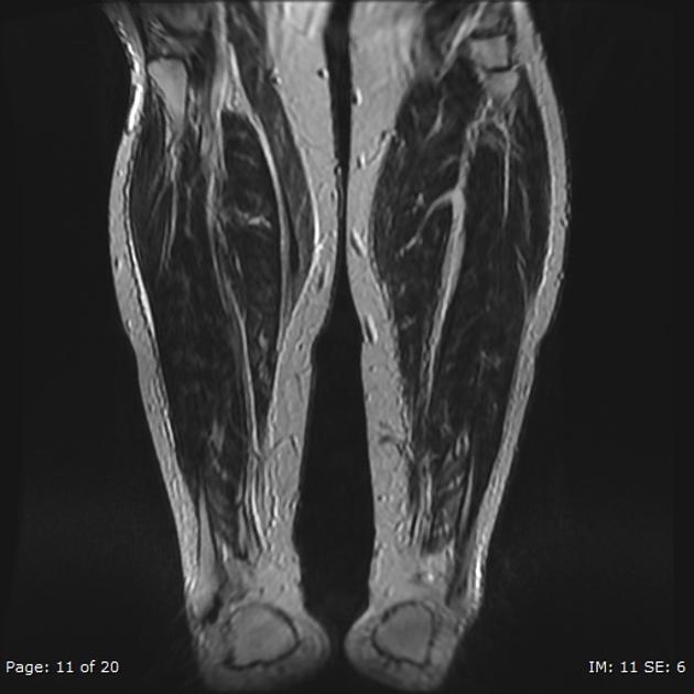 Radiology Quiz 29127 | Radiopaedia.org | Playlist 'MRI ankle/fot 