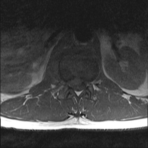 Discitis Osteomyelitis | Image | Radiopaedia.org