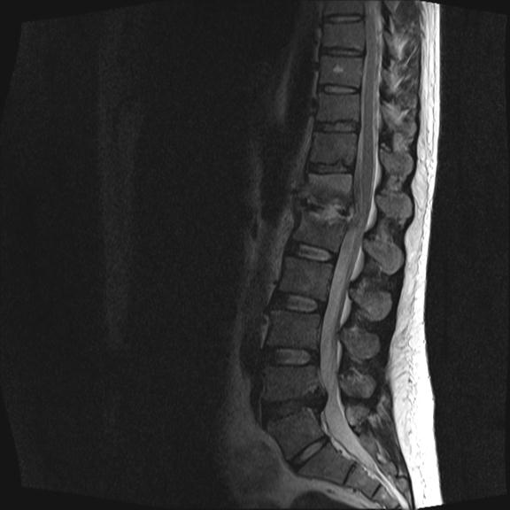 Discitis Osteomyelitis | Image | Radiopaedia.org