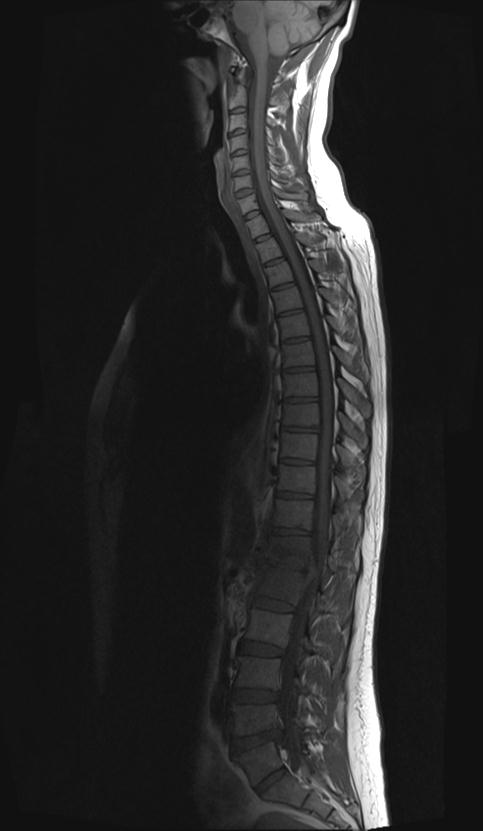 Discitis Osteomyelitis | Image | Radiopaedia.org