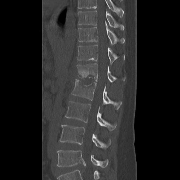 Spondylodiscitis | Radiology Reference Article | Radiopaedia.org