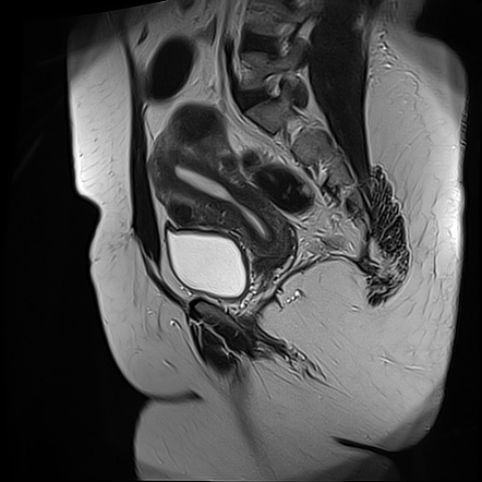 Multiple uterine leiomyomas | Radiology Case | Radiopaedia.org