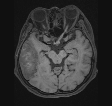 MR vessel wall imaging | Radiology Reference Article | Radiopaedia.org