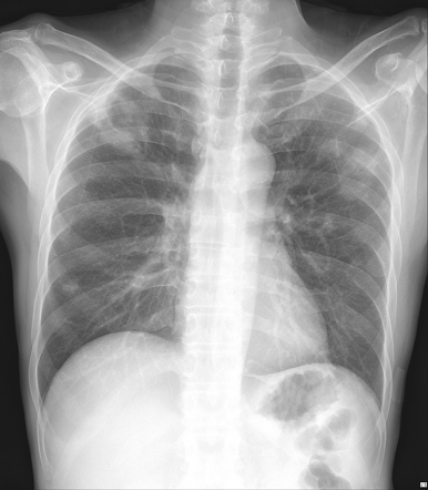 Disseminated Tb - Lung, Liver Abscess, Cutaneous Fistula 