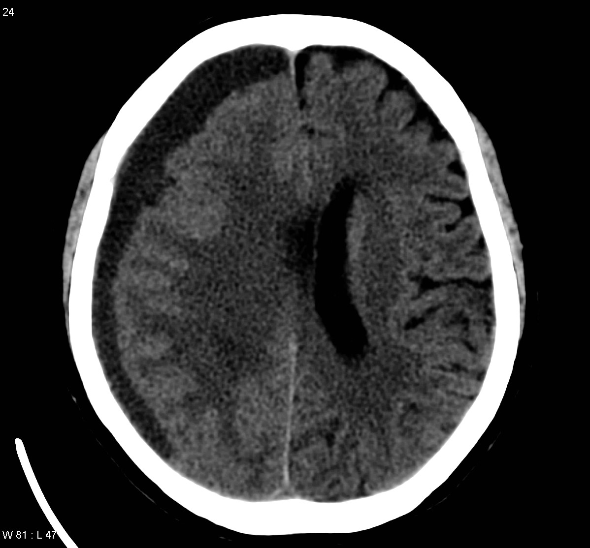 Hominick Hematoma