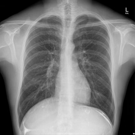 Barium peritonitis | Radiology Reference Article | Radiopaedia.org