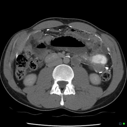 Barium Peritonitis Radiology Reference Article Radiopaedia Org