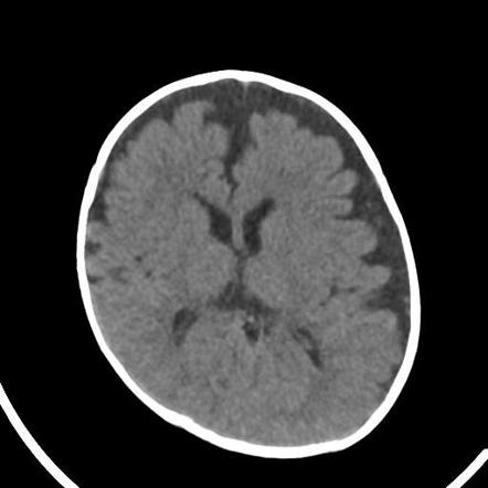 Subdural Hemorrhage Radiology Reference Article Radiopaedia Org