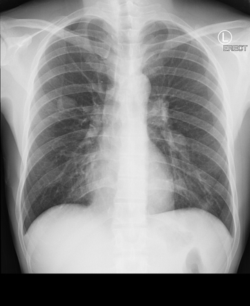 Hughes-Stovin syndrome (HSS) | Radiology Case | Radiopaedia.org