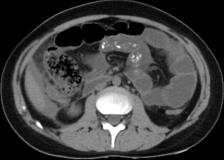 Complicated acute appendicitis | Radiology Case | Radiopaedia.org