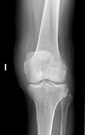 Patellar fracture | Radiology Case | Radiopaedia.org