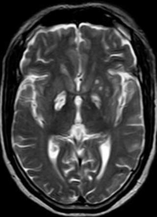 Basal ganglia T2 hyperintensity | Radiology Reference Article ...