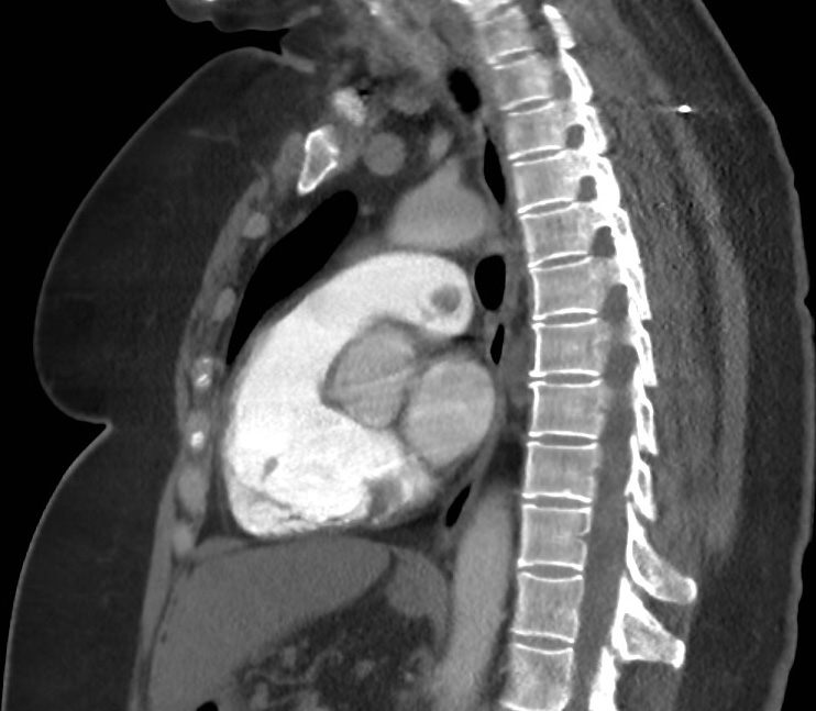 Saddle pulmonary embolus with Westermark sign | Image | Radiopaedia.org