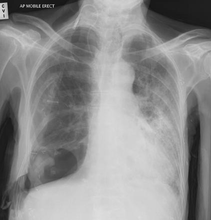 Clagett thoracotomy | Radiology Reference Article | Radiopaedia.org