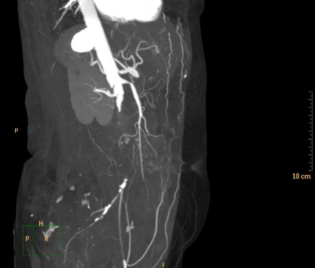 Aortoiliac occlusive disease Radiology Reference Article