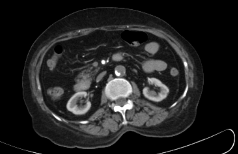 Aortoiliac occlusive disease | Image | Radiopaedia.org