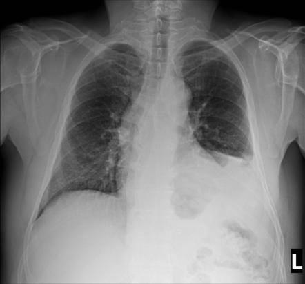 Phrenic nerve palsy | Radiology Reference Article | Radiopaedia.org