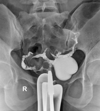 Caesarean scar isthmocele | Radiology Case | Radiopaedia.org