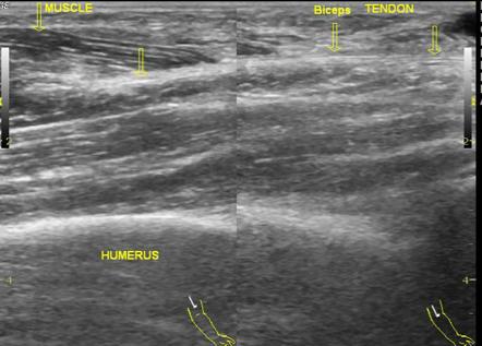 Biceps muscle tear | Image | Radiopaedia.org