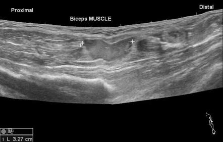 Biceps muscle tear | Image | Radiopaedia.org