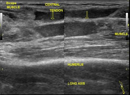 Biceps muscle tear | Image | Radiopaedia.org