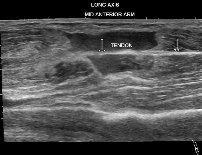 Biceps muscle tear | Image | Radiopaedia.org