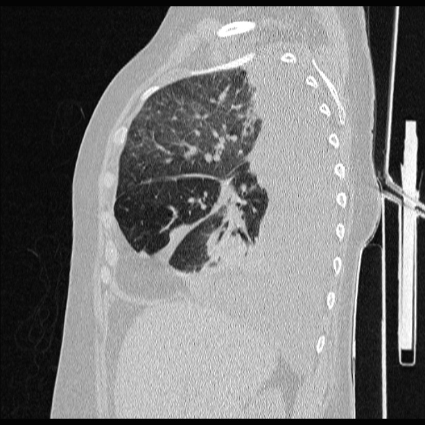 Cardiogenic pulmonary edema | Image | Radiopaedia.org