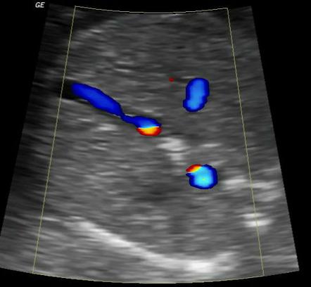 Fetal intrahepatic calcification | Image | Radiopaedia.org