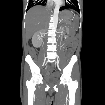 Active lower gastrointestinal bleeding - small bowel MALToma ...