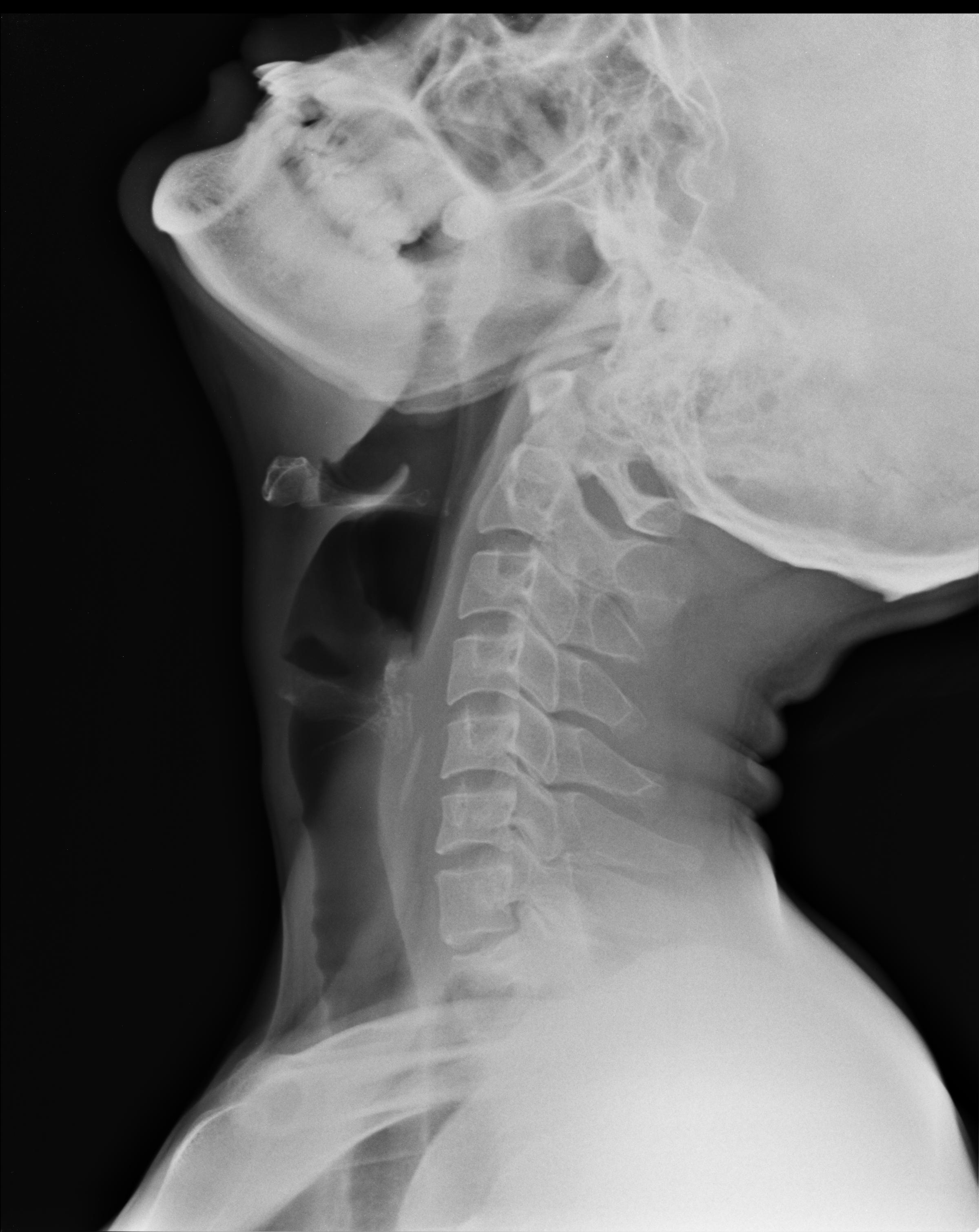 Soft Tissue X Ray Of The Neck Soft Tissue Neck X Ray The Best Porn Website