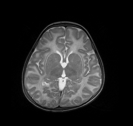 GM1 gangliosidosis | Radiology Case | Radiopaedia.org