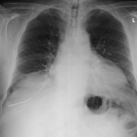 Playlist 'Basic chest x-ray pathology' by Dr Henry Knipe