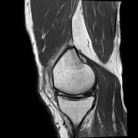 Bucket handle tear - medial meniscus | Radiology Case | Radiopaedia.org