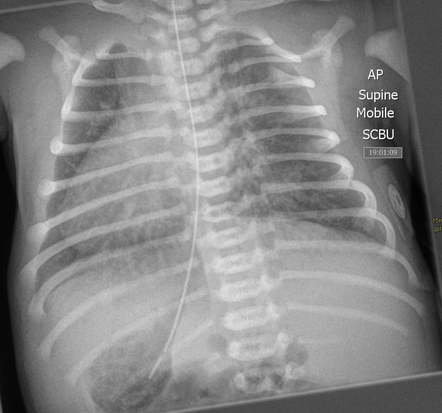 Situs inversus (neonatal) | Radiology Case | Radiopaedia.org