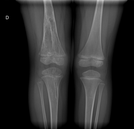 Enchondromatosis - Ollier disease | Radiology Case | Radiopaedia.org