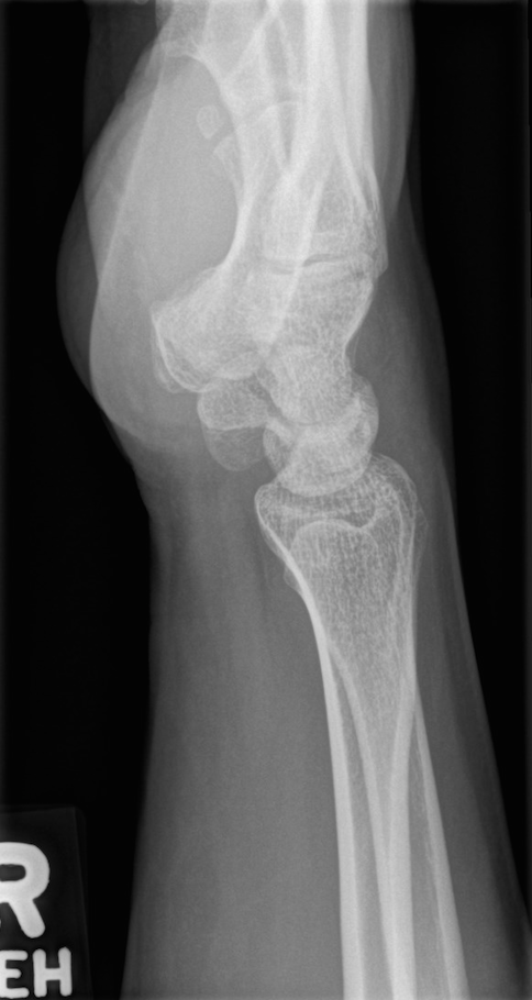 Pisiform fracture | Image | Radiopaedia.org